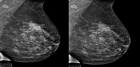 Tomosynthesis With Synthetic Mammography Improves Breast Cancer Detection