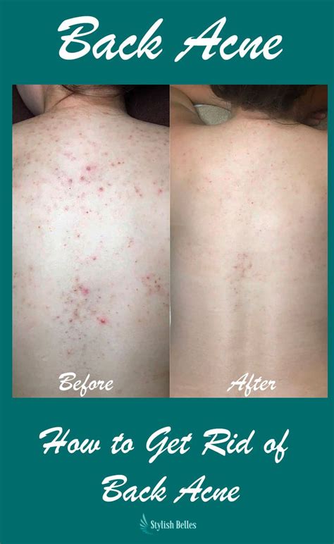 How To Get Rid Of Back Acne Stylish Belles How To Get Rid Of Acne