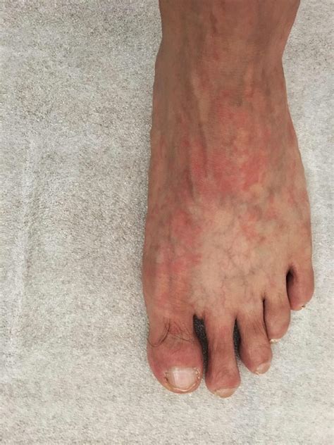 Swollen Feet With Rash