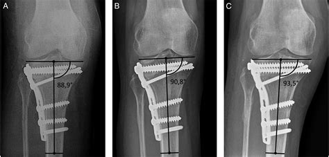 Tibial Plateau Fracture Orif