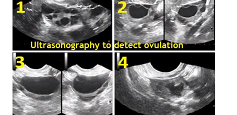 Ultrasound Scanning Of Ovulation Folliculometry Photo