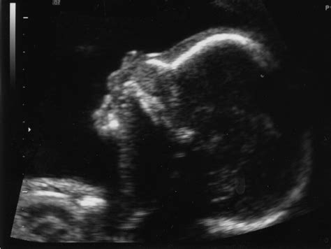 Baby Head Ultrasoundpng Hi Res 720p Hd