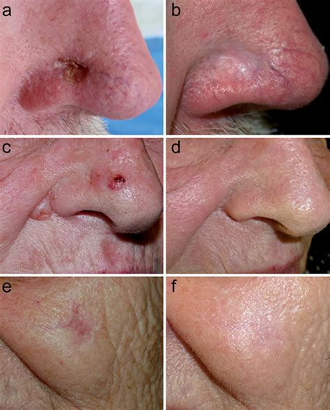 Basal Cell Carcinoma Before And After