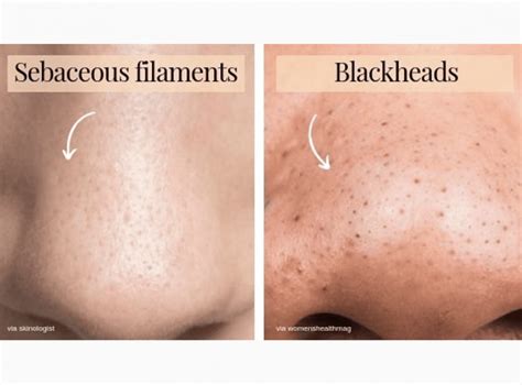 Sebaceous Filaments Vs Blackheads Z Cosmetic Health Blog