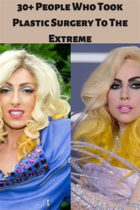 30 People Who Took Plastic Surgery To The Extreme In 2023 Celebrities Plastic Surgery