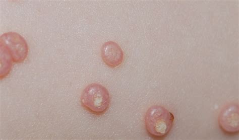 Natural Ways To Treat Molluscum Contagiosum Plant Medicine News