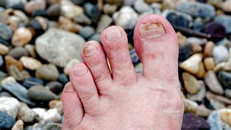 Toenail Discoloration Causes Related Symptoms Treatments