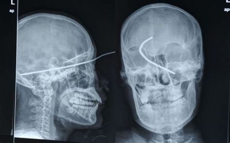 Real X Rays That Will Shock You 22 Pics Izismile Com