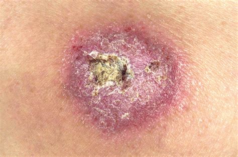 Differential Diagnoses Crusted Skin Lesions Gponline
