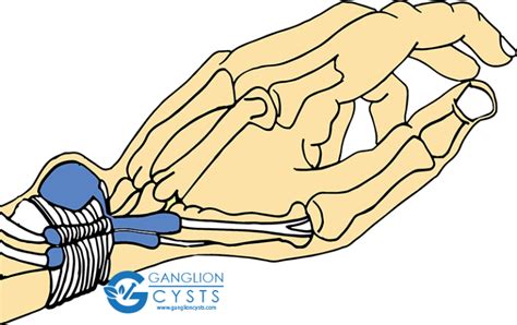 Ganglion Cysts Information Treatments And Remedies