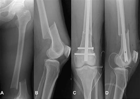 Knee Joint X Ray Showing Fracture Distal Femur Thigh Bone On Dipinti Sexiz Pix