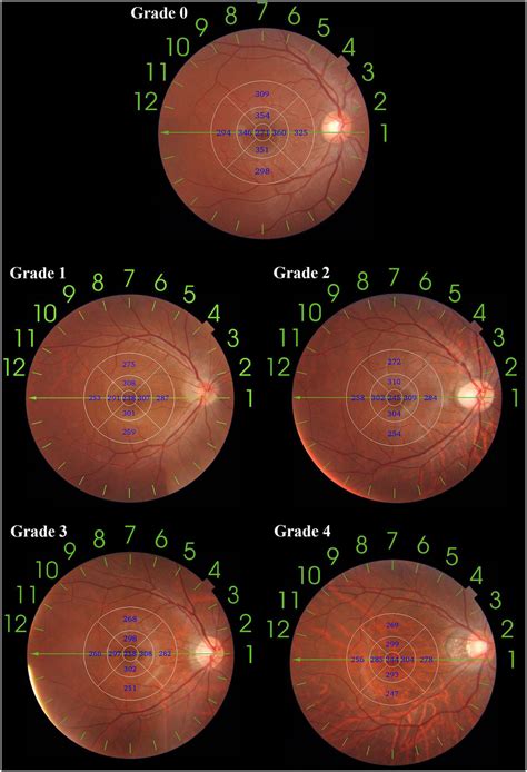An Application Of Etdrs Grid On Fundus Tessellation Grading The