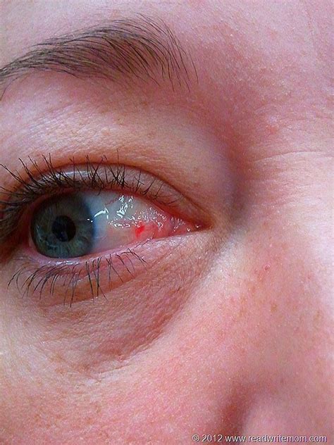 Find out what the appearance of a red spot on the eye means and what its causes are. There's A Red Bump On My Eyeball