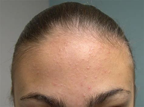 Bumps On Forehead Skin Bumps Forehead Bumps Forehead Acne