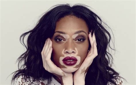 Winnie Harlow La Modella Con La Vitiligine Io Non Sono La Mia Pelle