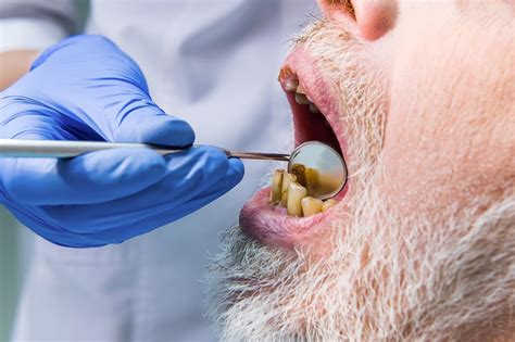 Teeth Of Methamphetamine Use Before And After