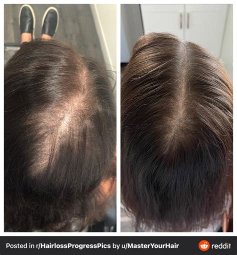 progress pics female with androgenic alopecia sept 2020 vs nov 2021 prp microneedling