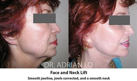 Before And After Face And Neck Lift Philadelphia Pa Dr Adrian Lo