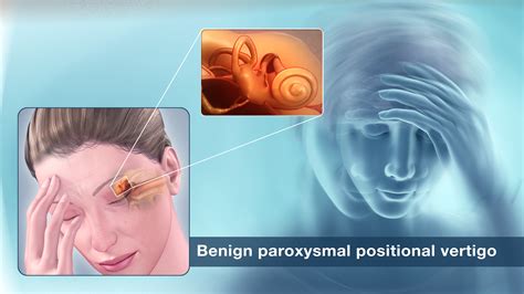 Benign Paroxysmal Positional Vertigo Shown Via Medical Animation Still