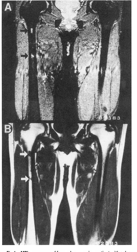 Figure 4 From Magnetic Resonance Imaging Of Femoral Marrow In Patients