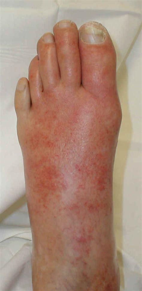 Cellulitis Foot Medical Pictures Info Health Definitions Photos