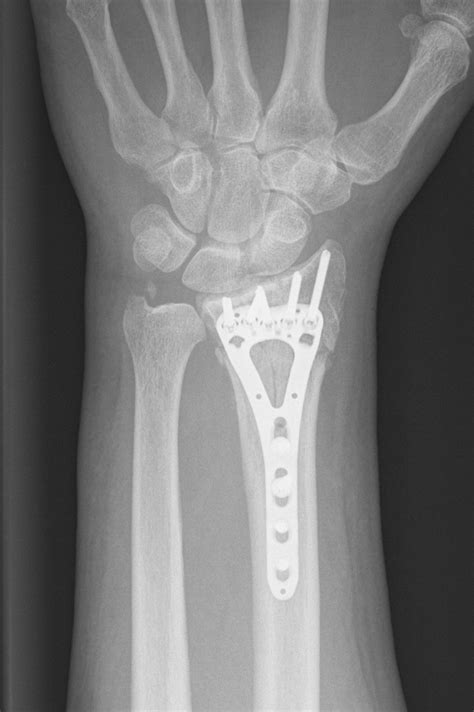 Distal Radius Colles Fracture — Dr Mark Hile Wrist And Hand Specialist