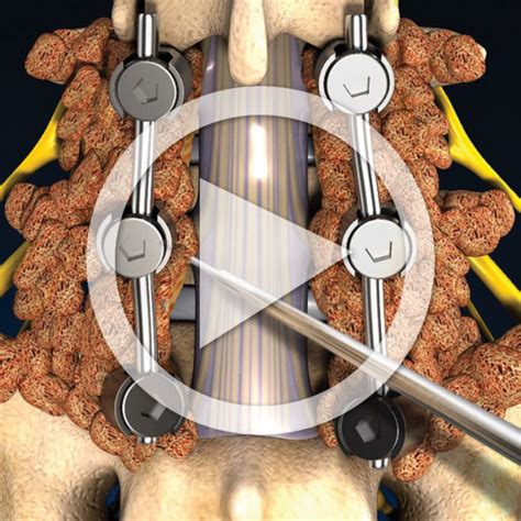 Posterolateral Lumbar Pedicle Screw Fusion Trialexhibits Inc