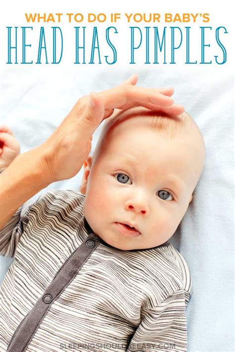 How To Treat Pimples On Babys Head Sleeping Should Be Easy
