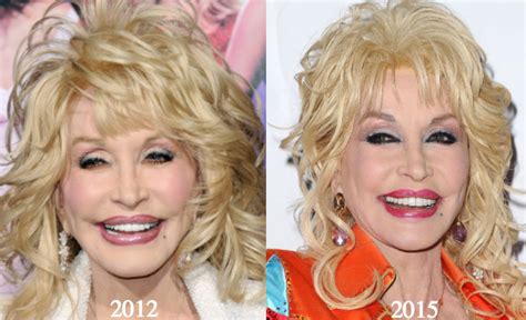 Dolly Parton Plastic Surgery Before and After Photos