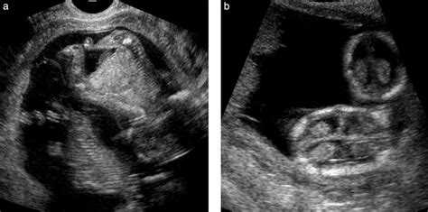 5 Weeks Pregnant Ultrasound Triplets What Life Is Like Pregnant With