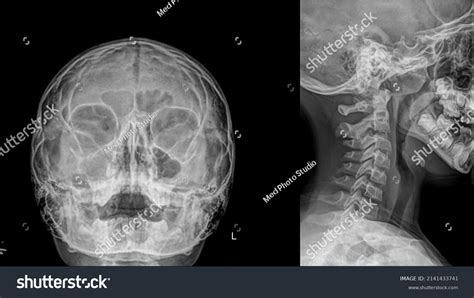 Pns De Radiografía Radiografía Sinusal Paranasal Foto De Stock