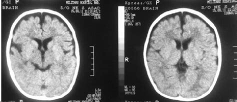 Ct Scan Brain Of The Patient Showing Cerebral Atrophy And Prominence Of