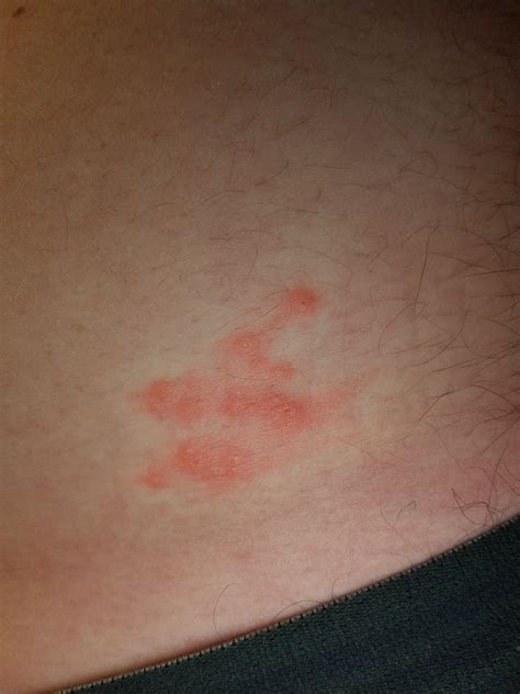 this kind of bumpy rash has shown up on my stomach just above my waistband it is itchy and has