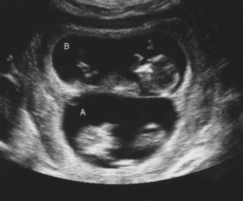 Picture Of Twins Ultrasound System Photopng