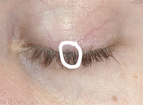 Dark Spot On The Eyelid Web Eye Clinic