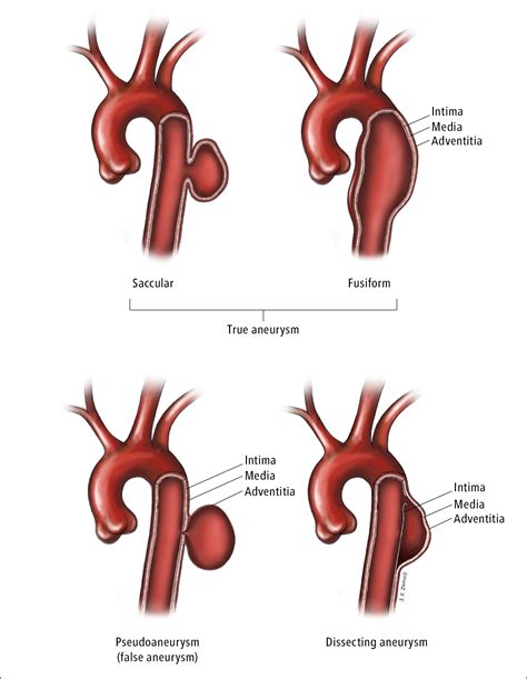 Life Expectancy After Thoracic Aortic Aneurysm Surgery Good Life