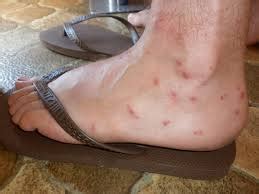 Sand Flea Bites Photos Diagnosis Causes Risk Treatments