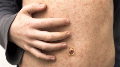 Seven Cases Of Measles Linked To Stoke On Trent School And Nursery