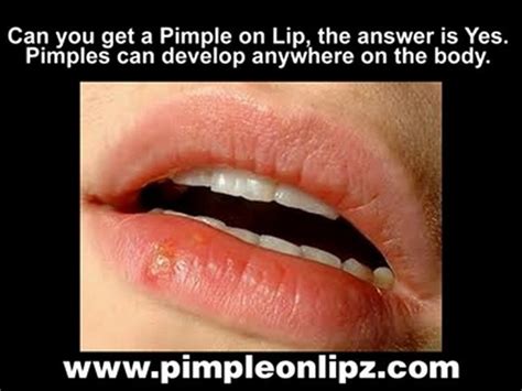 Pimple On Lip How To Effectlively Treat A Pimple On Lip Video