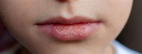 Chapped Lips Causes And Remedies Holland And Barrett