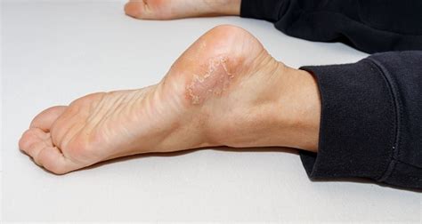 Dyshidrotic Eczema Skin Disease On Foot Heel Against White Background