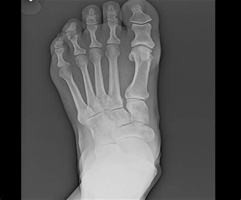 Ortho Dx Increased Forefoot Pain When Metatarsal Heads Squeezed