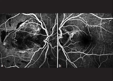 Ocular Involvement In Tumoral Calcinosis Bhattacharjee H Bhattacharjee