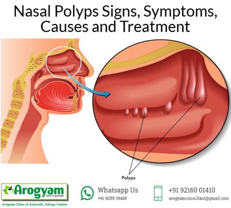 Nasal Polyps Signs Symptoms Causes And Treatment Polyp Polyps Symptoms Treatment