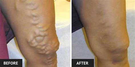 Shared Health News How To Get Rid Of Varicose Veins