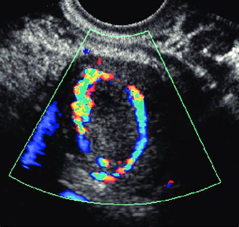 ultrasound appearance of corpus luteum cyst