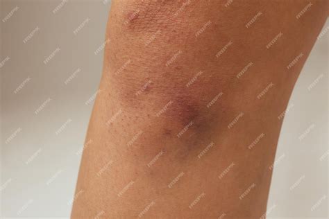 Premium Photo Hematoma And Large Bruise Blood Under Skin Congestion