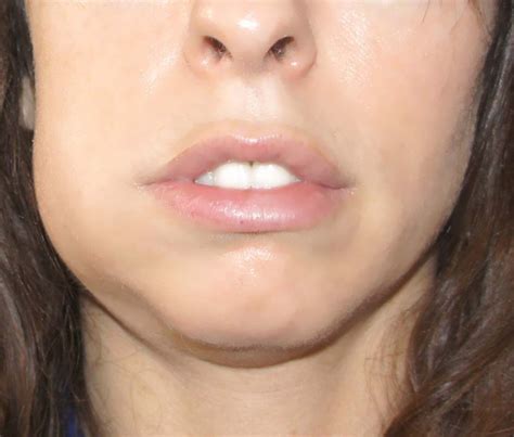 How To Deal With Swollen Face From Tooth Infection New Health Advisor