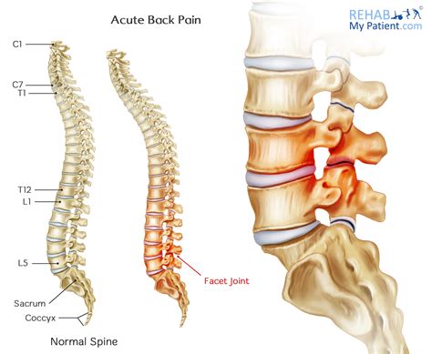 Because of this, they are referred to as cause and. Lower Back Bones Diagram : Lumbar Vertebrae Wikipedia ...