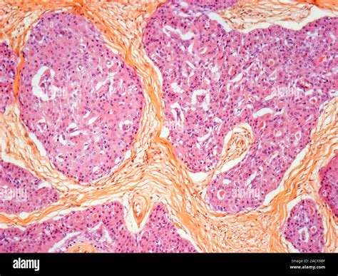 Salivary Gland Oncocytoma Light Micrograph Section Through An Area Of